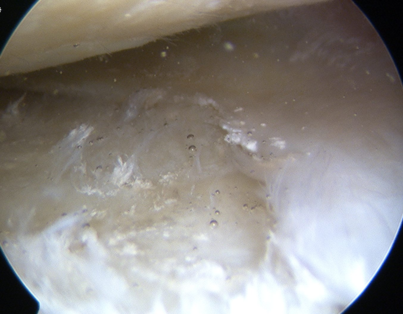 Chondrocalcinosis Knee 2